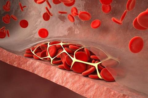 هل نقص الصفائح الدموية يسبب سرطان الدم؟